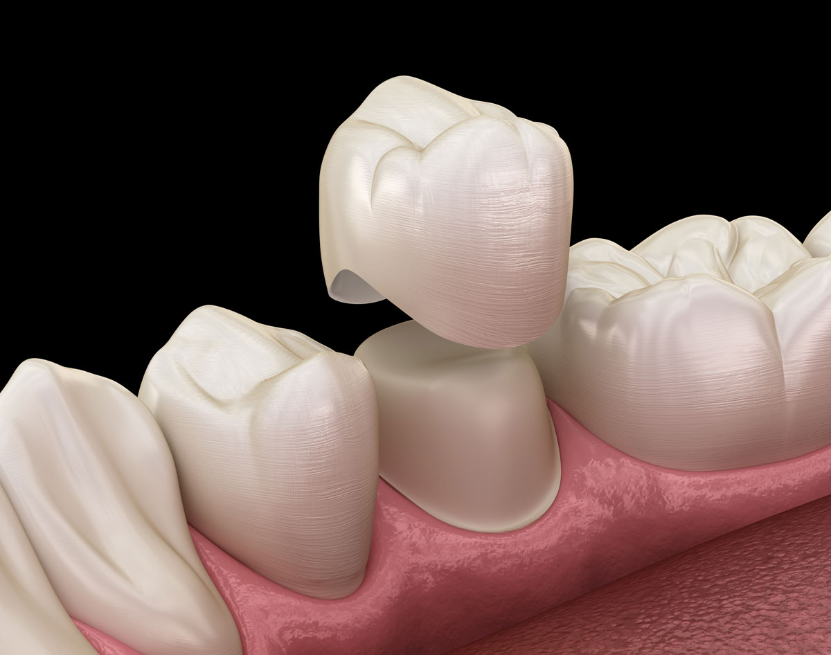 Corona dentale render 3d