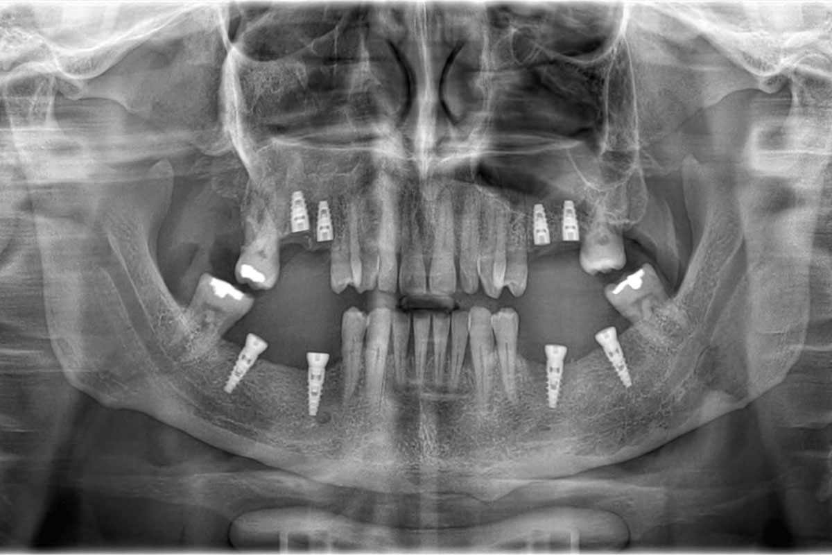 Panoramica bocca con impianti dentali