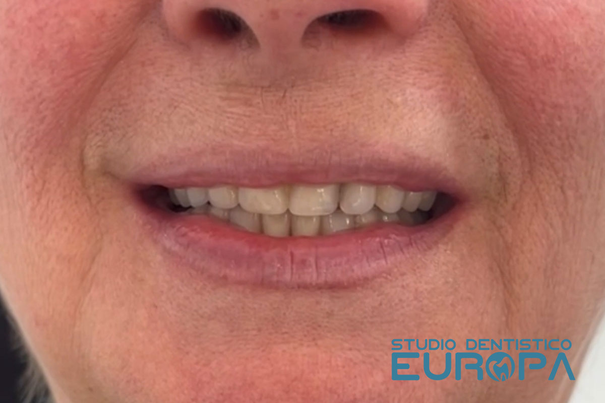 Impianti Dentali Studio Dentistico Europa