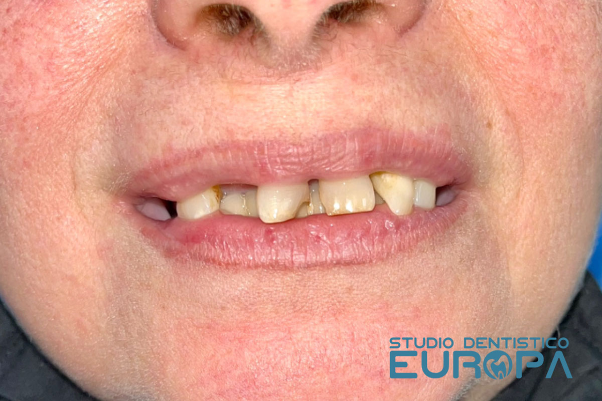 Impianti Dentali Studio Dentistico Europa Impianti Dentali Studio Dentistico Europa