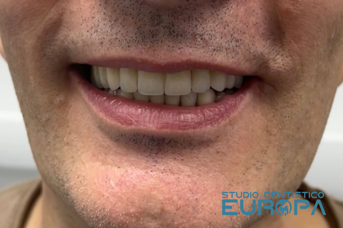 Impianti Dentali Studio Dentistico Europa