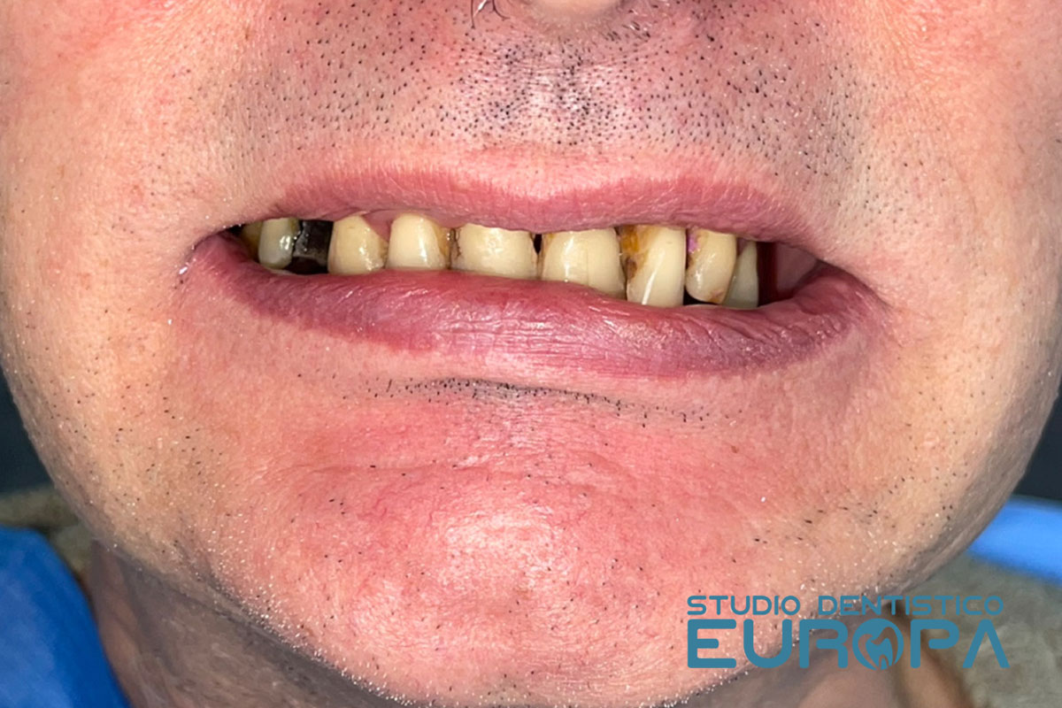 Impianti Dentali Studio Dentistico Europa Impianti Dentali Studio Dentistico Europa